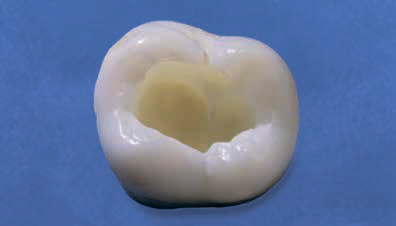 Ecusphere Shape A3.5 - полость I класса